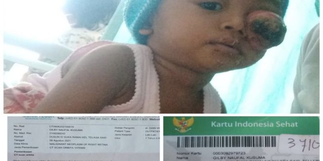 Komunitas GJS dan Sedulur Selawase Ajak Donasi untuk Penderita Tumor Mata di Langkat